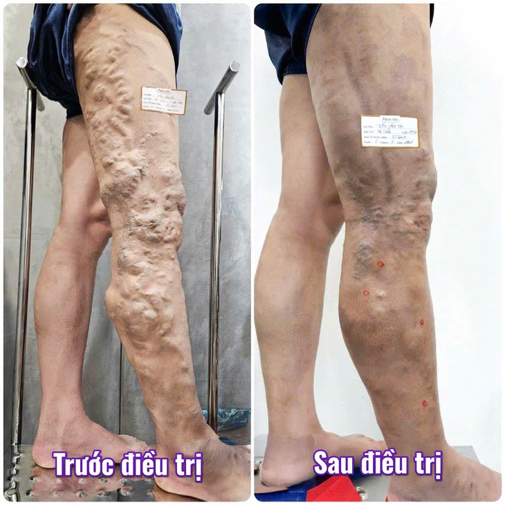 Điều trị dị dạng tĩnh mạch tại Phòng khám nội tĩnh mạch An Viên Hà Nội- Ảnh 3. Điều trị dị dạng tĩnh mạch tại Phòng khám nội tĩnh mạch An Viên Hà Nội- Ảnh 3.