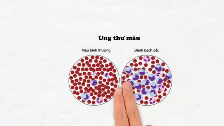 Câu hỏi thường gặp liên quan đến bệnh leukemia kinh dòng bạch cầu hạt- Ảnh 1.