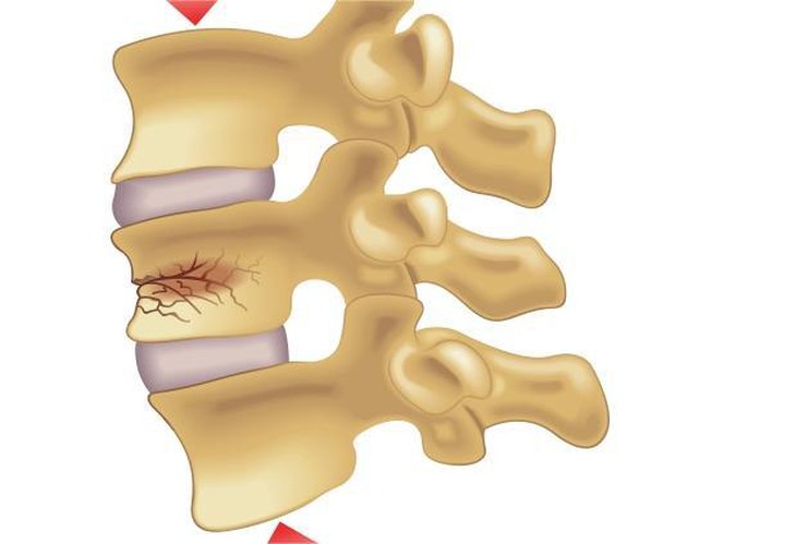 Bài tập cho người xẹp đốt sống- Ảnh 1.