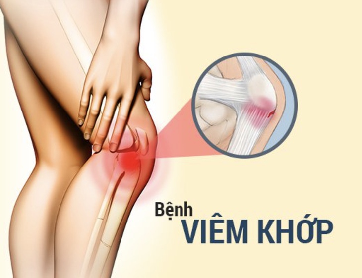 Viêm khớp: Nguyên nhân, triệu chứng, cách điều trị và phòng ngừa- Ảnh 1. Viêm khớp: Nguyên nhân, triệu chứng, cách điều trị và phòng ngừa- Ảnh 1.