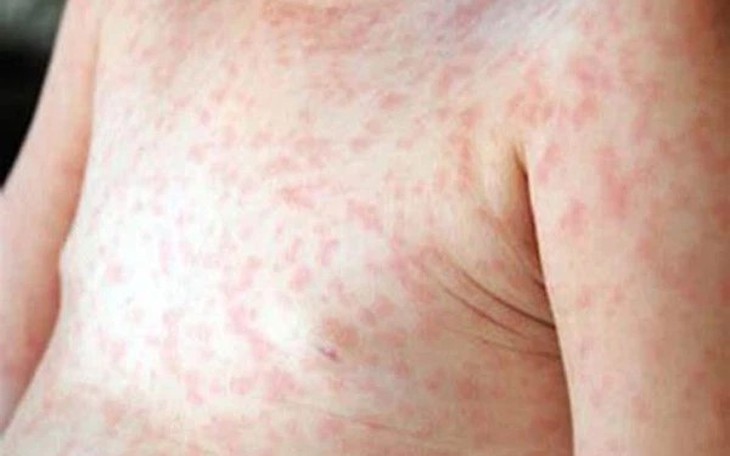 Xử lý triệt để các ổ dịch sốt xuất huyết ngay từ khi xuất hiện