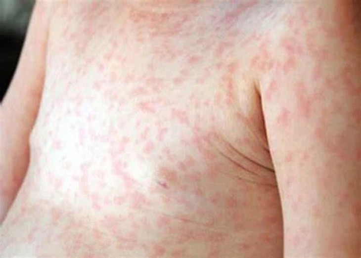 Xử lý triệt để các ổ dịch sốt xuất huyết ngay từ khi xuất hiện- Ảnh 3.