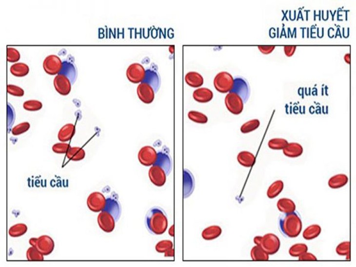 Bài tập tốt cho người bị xuất huyết giảm tiểu cầu- Ảnh 1.