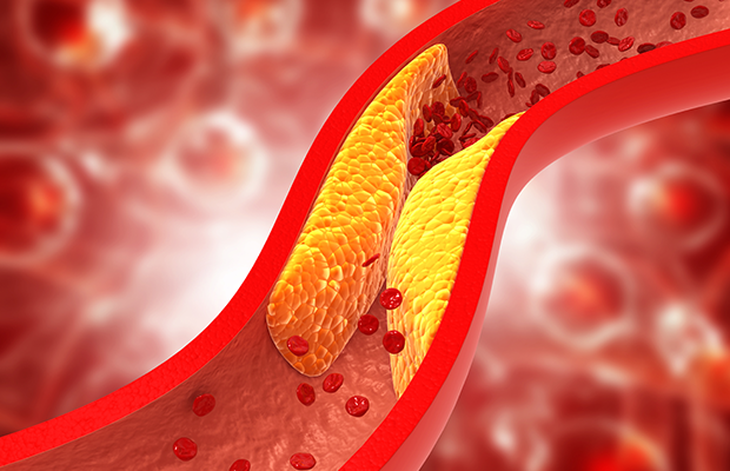 Cách giảm cholesterol ngăn ngừa bệnh tim- Ảnh 1. Cách giảm cholesterol ngăn ngừa bệnh tim- Ảnh 1.