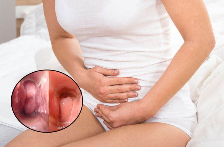 Viêm âm đạo và mối nguy hiểm với khả năng sinh sản- Ảnh 1.