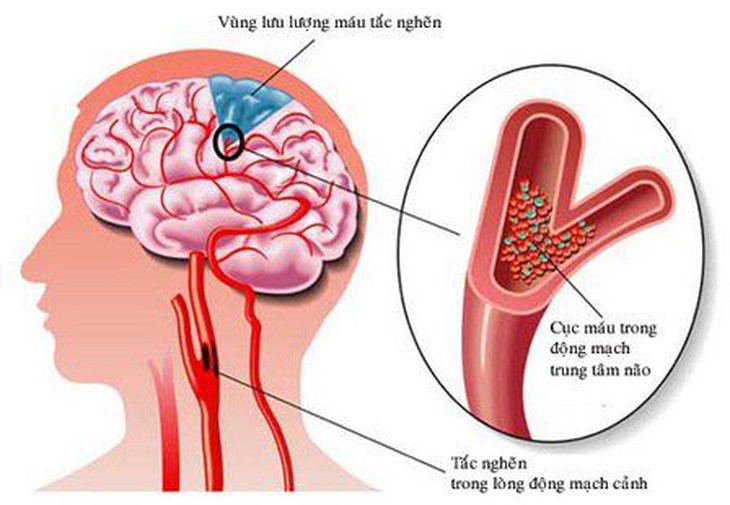Xơ vữa động mạch não: Nguyên nhân, triệu chứng, phòng bệnh và cách điều trị- Ảnh 3. Xơ vữa động mạch não: Nguyên nhân, triệu chứng, phòng bệnh và cách điều trị- Ảnh 3.