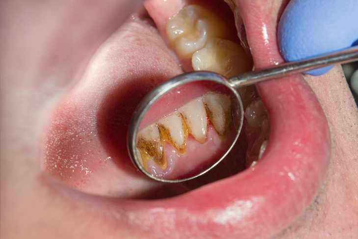 Tại sao cao răng gây hôi miệng và cách phòng tránh mảng bám cao răng- Ảnh 1.
