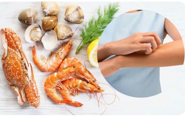 Đi du lịch biển, cần chú ý 6 loại hải sản dễ gây dị ứng nhất- Ảnh 3.