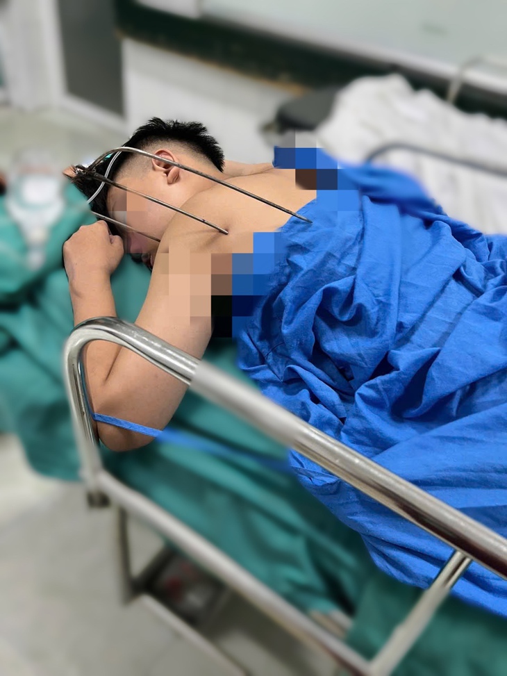 Thanh niên 17 tuổi nguy kịch do dị vật kim loại tự chế xuyên thấu tim - Ảnh 1.