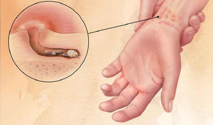 Câu hỏi thường gặp liên quan đến bệnh ghẻ- Ảnh 1. Câu hỏi thường gặp liên quan đến bệnh ghẻ- Ảnh 1.