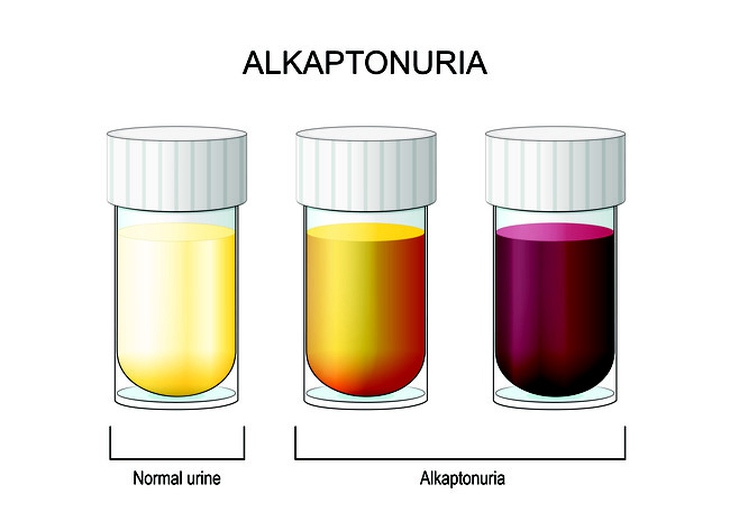 Bệnh alkapton niệu cần lưu ý gì về chế độ ăn?- Ảnh 1.