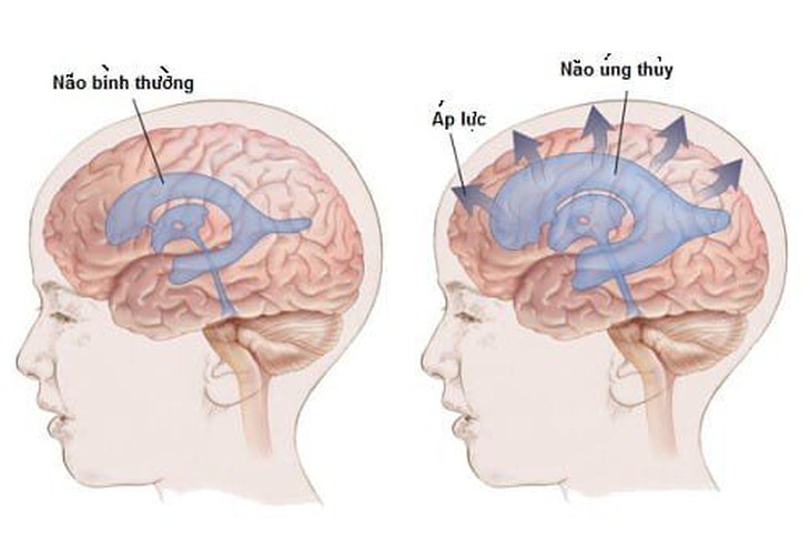 Câu hỏi thường gặp liên quan đến bệnh giãn não thất- Ảnh 1.