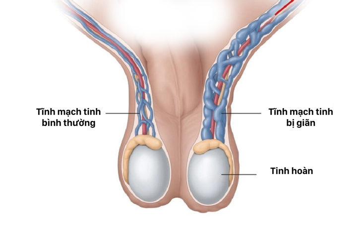 Câu hỏi thường gặp liên quan đến bệnh giãn tĩnh mạch thừng tinh- Ảnh 1.