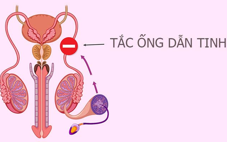 Tắc ống dẫn tinh: Nguyên nhân, triệu chứng và cách điều trị