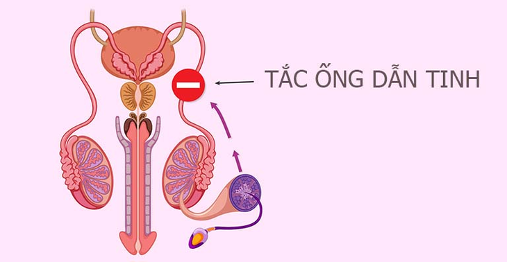 Tắc ống dẫn tinh: Nguyên nhân, triệu chứng và cách điều trị- Ảnh 2. Tắc ống dẫn tinh: Nguyên nhân, triệu chứng và cách điều trị- Ảnh 2.
