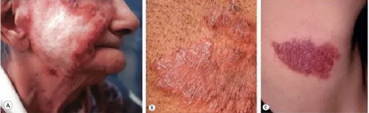 Lao da và mô dưới da: Nguyên nhân, biểu hiện, cách điều trị và phòng bệnh- Ảnh 1.