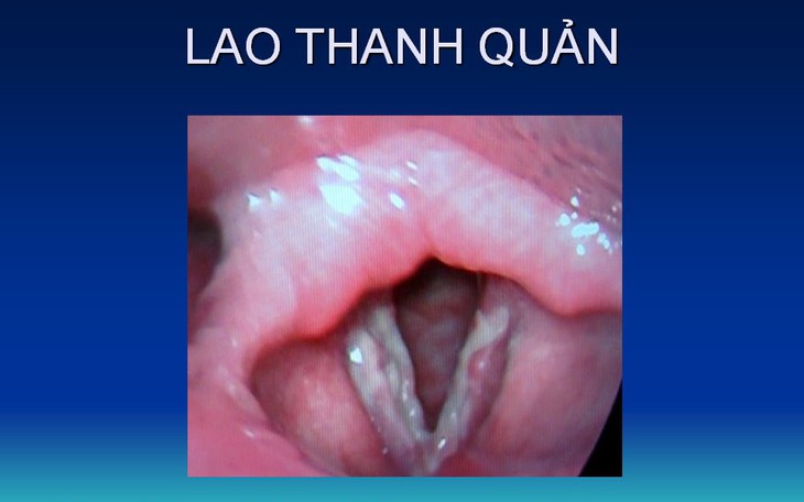 Lao thanh quản: Nguyên nhân, biểu hiện, cách điều trị và phòng bệnh