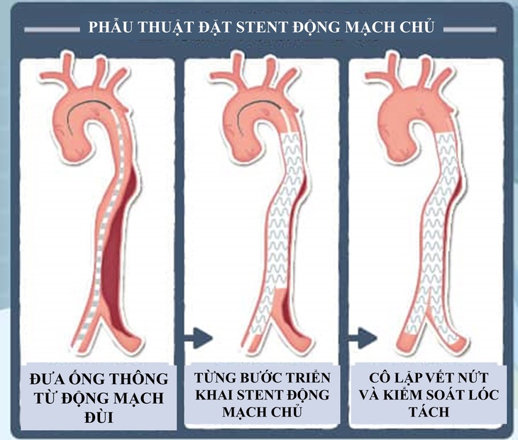 Lóc tách động mạch chủ: Nguyên nhân, biểu hiện, cách điều trị và phòng bệnh- Ảnh 1.