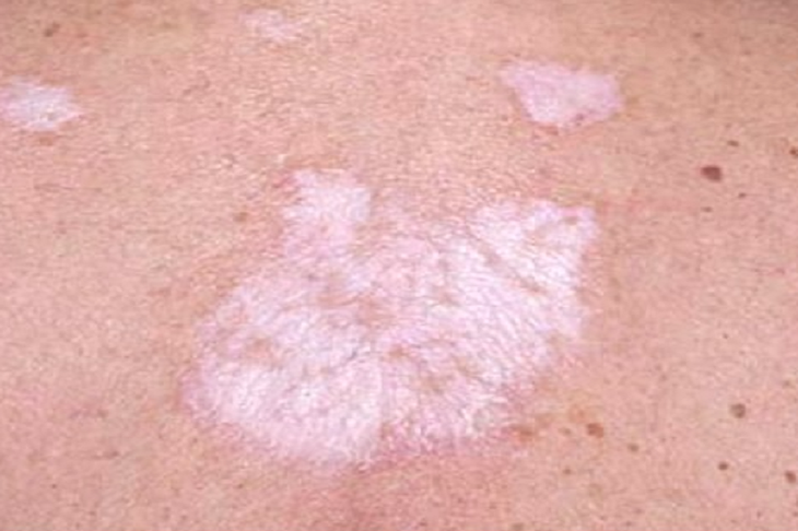 Lichen xơ hóa: Nguyên nhân, biểu hiện, cách điều trị và phòng bệnh- Ảnh 1.