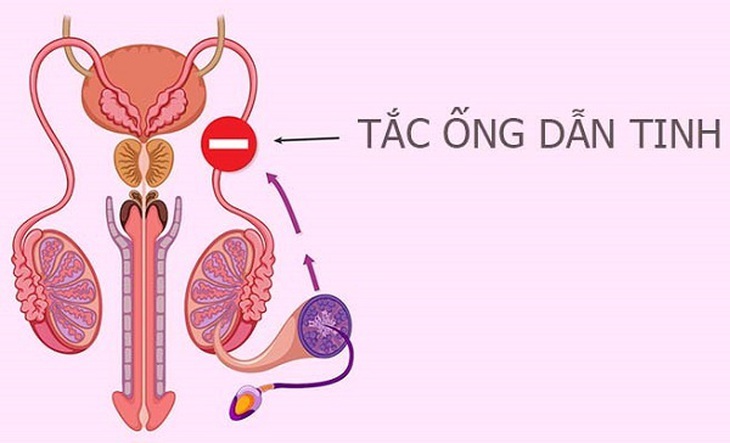 Các câu hỏi thường gặp về bệnh viêm tắc ống dẫn tinh- Ảnh 1.