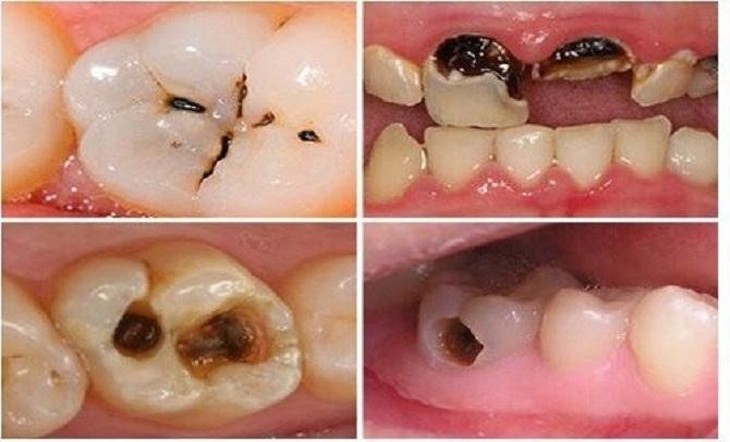 Chăm sóc răng miệng: Đánh răng thôi đã đủ chưa?- Ảnh 1.