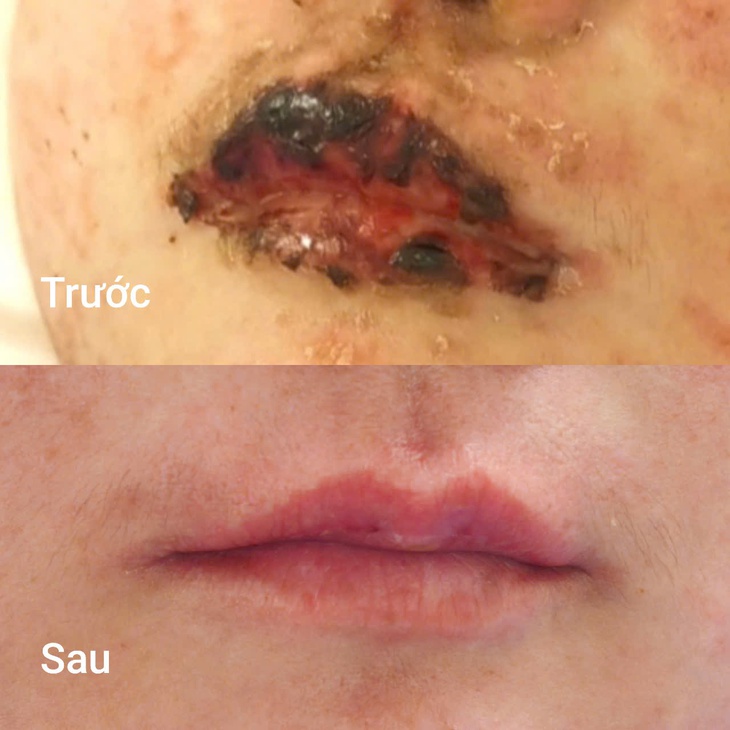 Môi tím đen như trúng độc sau một ngày tự uống thuốc cảm- Ảnh 1.
