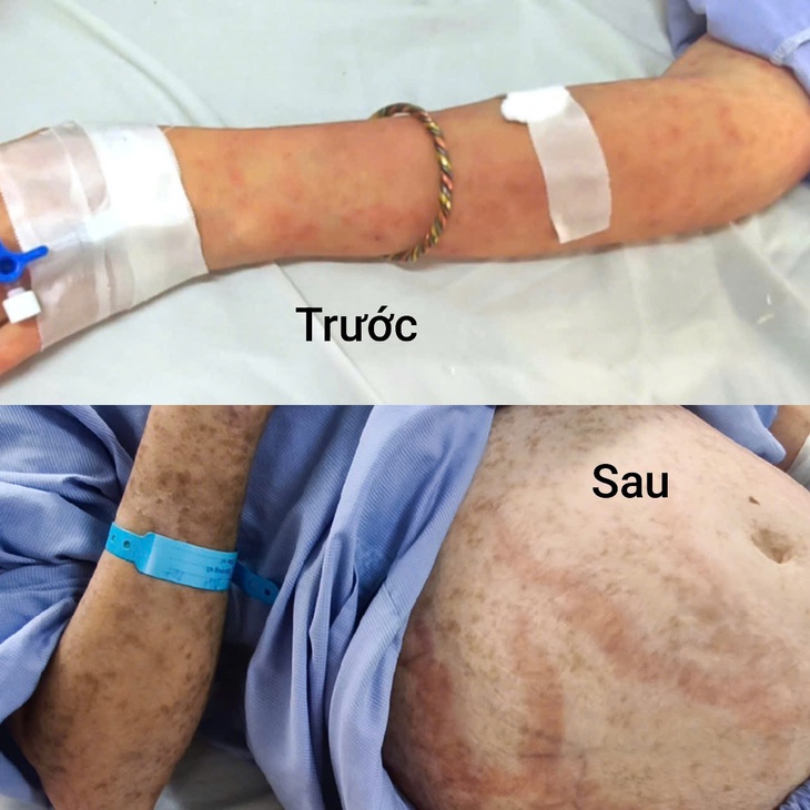 Môi tím đen như trúng độc sau một ngày tự uống thuốc cảm- Ảnh 2.