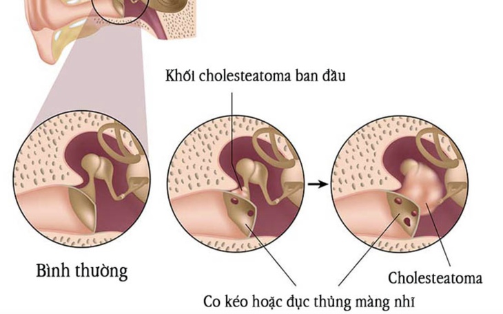 Viêm tai xương chũm: Nguyên nhân, triệu chứng, cách điều trị và phòng ngừa