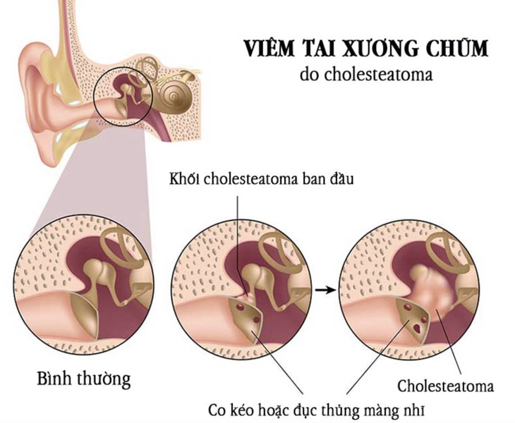 Viêm tai xương chũm: Nguyên nhân, triệu chứng, cách điều trị và phòng ngừa- Ảnh 1.