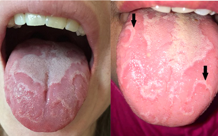 Những yếu tố làm tăng nguy cơ mắc lưỡi bản đồ- Ảnh 1.