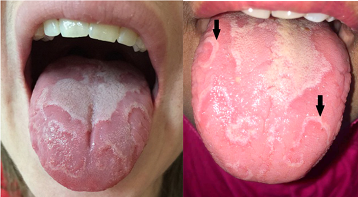 Câu hỏi thường gặp về lưỡi bản đồ- Ảnh 1.