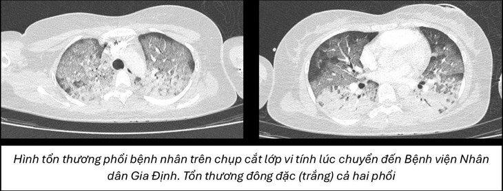 Cô gái sốc phản vệ nặng sau gây mê nâng mũi- Ảnh 1.