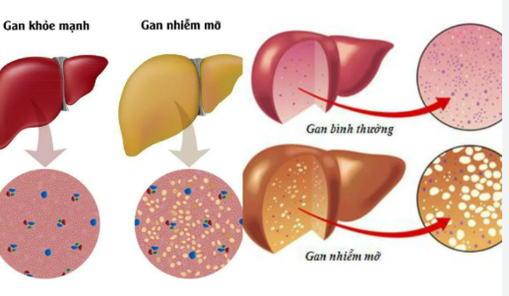 Người bị gan nhiễm mỡ có cần dùng thuốc bổ gan?- Ảnh 1.