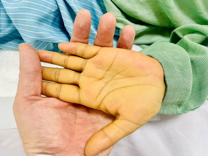 Thay huyết tương 4 lần cứu sống bệnh nhân ung thư vú bị suy gan cấp- Ảnh 3.