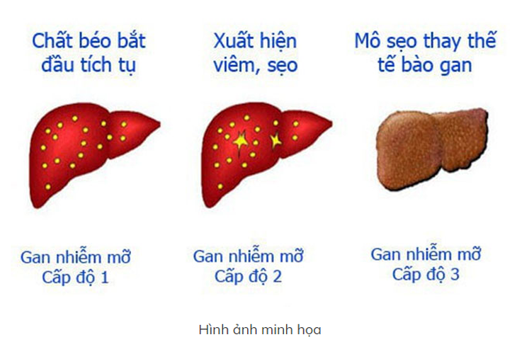 5 bài thuốc từ cỏ nhọ nồi trị gan nhiễm mỡ- Ảnh 1.
