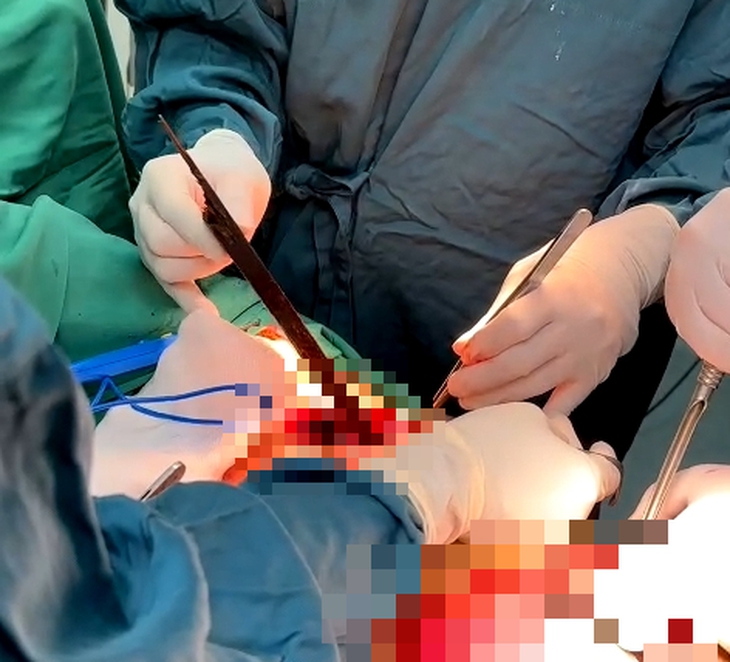 Cứu sống ngoạn mục nam thanh niên bị thanh gỗ đâm thấu ngực- Ảnh 2. Cứu sống ngoạn mục nam thanh niên bị thanh gỗ đâm thấu ngực- Ảnh 2.