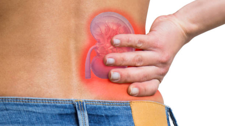 Vitamin D tăng cường hấp thụ canxi có thể dẫn đến hình thành sỏi thận