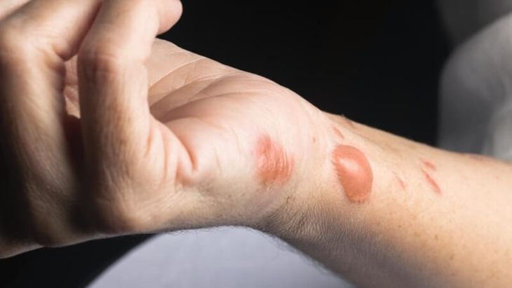 Rắc bột kháng sinh lên vết bỏng, nguy cơ sốc phản vệ có thể gây tử vong- Ảnh 1. Rắc bột kháng sinh lên vết bỏng, nguy cơ sốc phản vệ có thể gây tử vong- Ảnh 1.