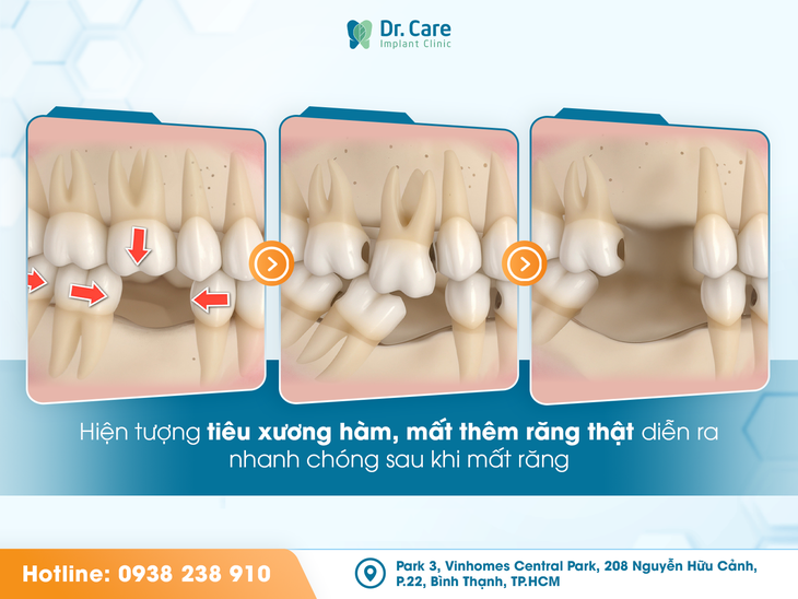 Trồng Implant toàn hàm: hy vọng cho người mất răng lâu năm, tiêu xương!- Ảnh 1.