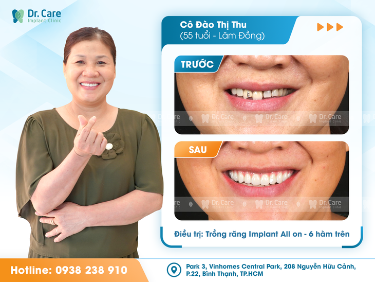 Trồng răng Implant với công nghệ hiện đại tại Dr. Care- Ảnh 2.