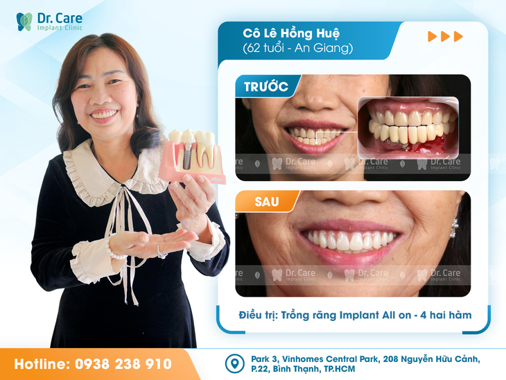 Trồng Implant toàn hàm: hy vọng cho người mất răng lâu năm, tiêu xương!- Ảnh 2.