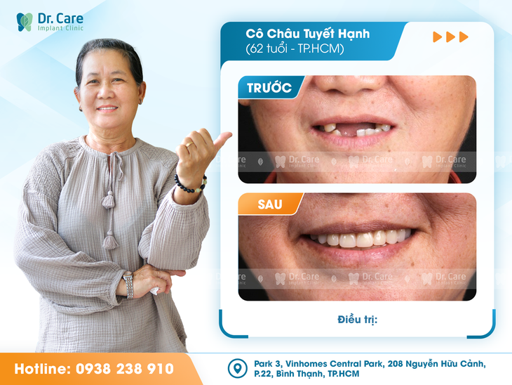 Trồng Implant toàn hàm: hy vọng cho người mất răng lâu năm, tiêu xương!- Ảnh 3.