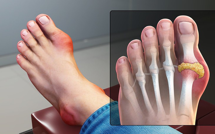Người có nguy cơ cao mắc bệnh gout cần lưu ý gì?