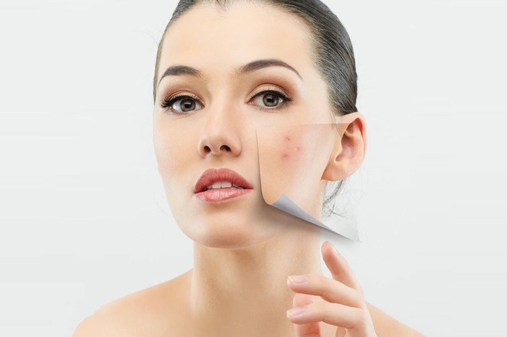 Cách trị mụn trứng cá hiệu quả nhất- Ảnh 2.