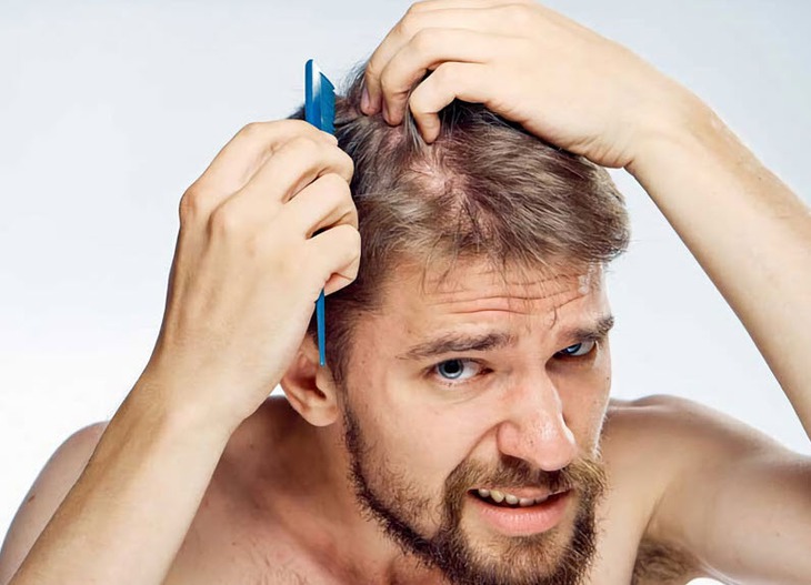 Rụng tóc ở nam giới và giải pháp khắc phục- Ảnh 1. Rụng tóc ở nam giới và giải pháp khắc phục- Ảnh 1.