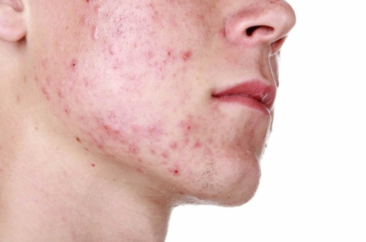 Cách trị mụn trứng cá hiệu quả nhất- Ảnh 1.