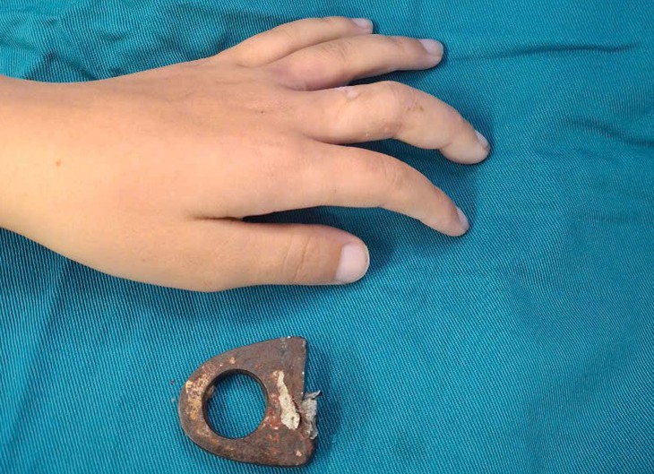 Vòng khóa siết ngón tay bé trai, gia đình cưa cửa mang đến viện- Ảnh 1. Vòng khóa siết ngón tay bé trai, gia đình cưa cửa mang đến viện- Ảnh 1.