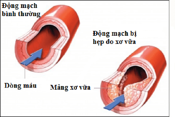 Xơ vữa động mạch: Bệnh lý nguy hiểm nhưng dễ bị bỏ qua- Ảnh 1. Xơ vữa động mạch: Bệnh lý nguy hiểm nhưng dễ bị bỏ qua- Ảnh 1.