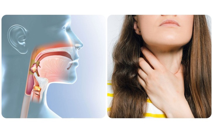 Biểu hiện cảnh báo ung thư vòm họng giai đoạn đầu