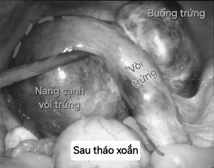 Bệnh viện tuyến quận cấp cứu thành công hai ca xoắn cơ quan sinh dục nguy hiểm- Ảnh 2.